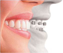 Выравнивание зубов прозрачными каппами ОртоСнэп